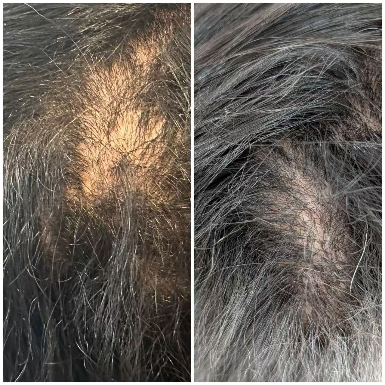 vorher-nachher-mehr-haardichte-nach-anwendung-von-harvekst
