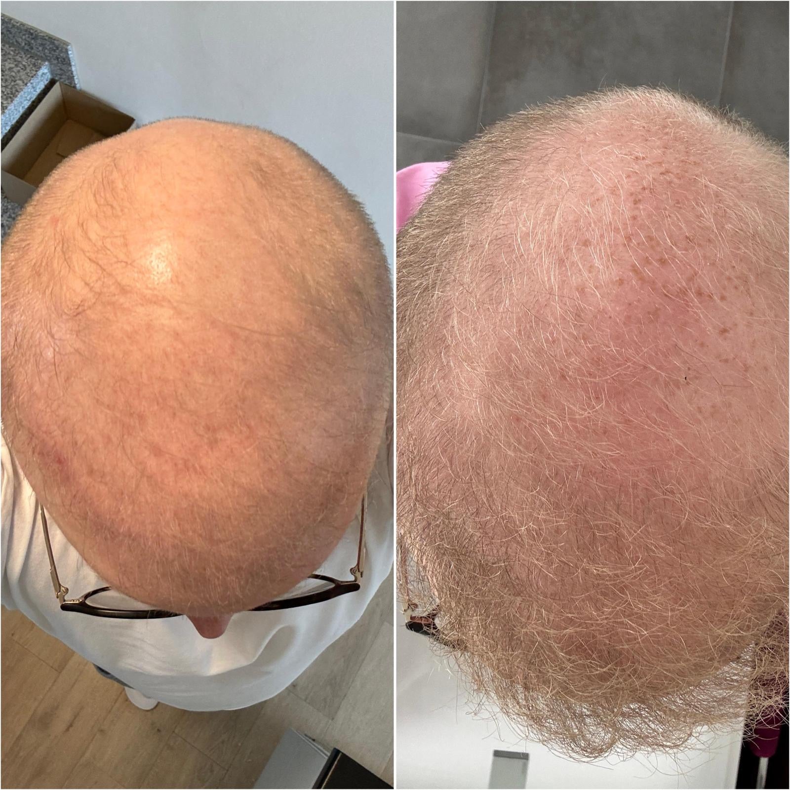 vorher-nachher-haarausfall-reduziert-durch-harvekst-serum